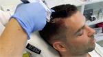 HaartransplantatieTurkije